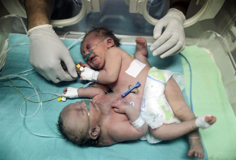 Conjoined Gaza twins separated in 'successful' Saudi op