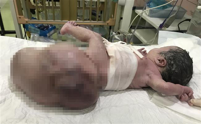 Tumor as big as her body removed from newborn girl