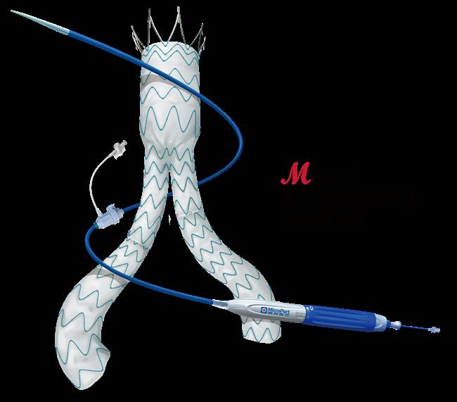 Domestically-developed aneurysm treatment gets certified