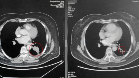 China's approval for new lung cancer drug - SHINE News