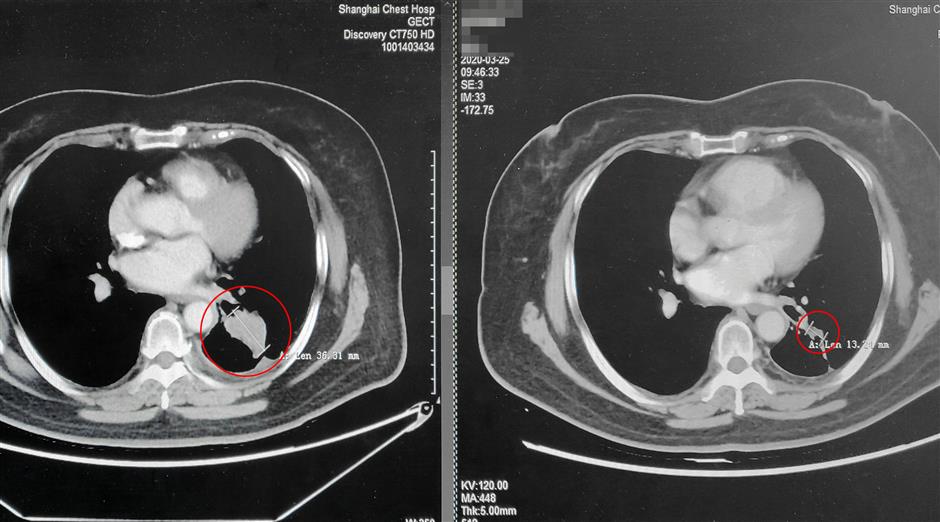 China's approval for new lung cancer drug