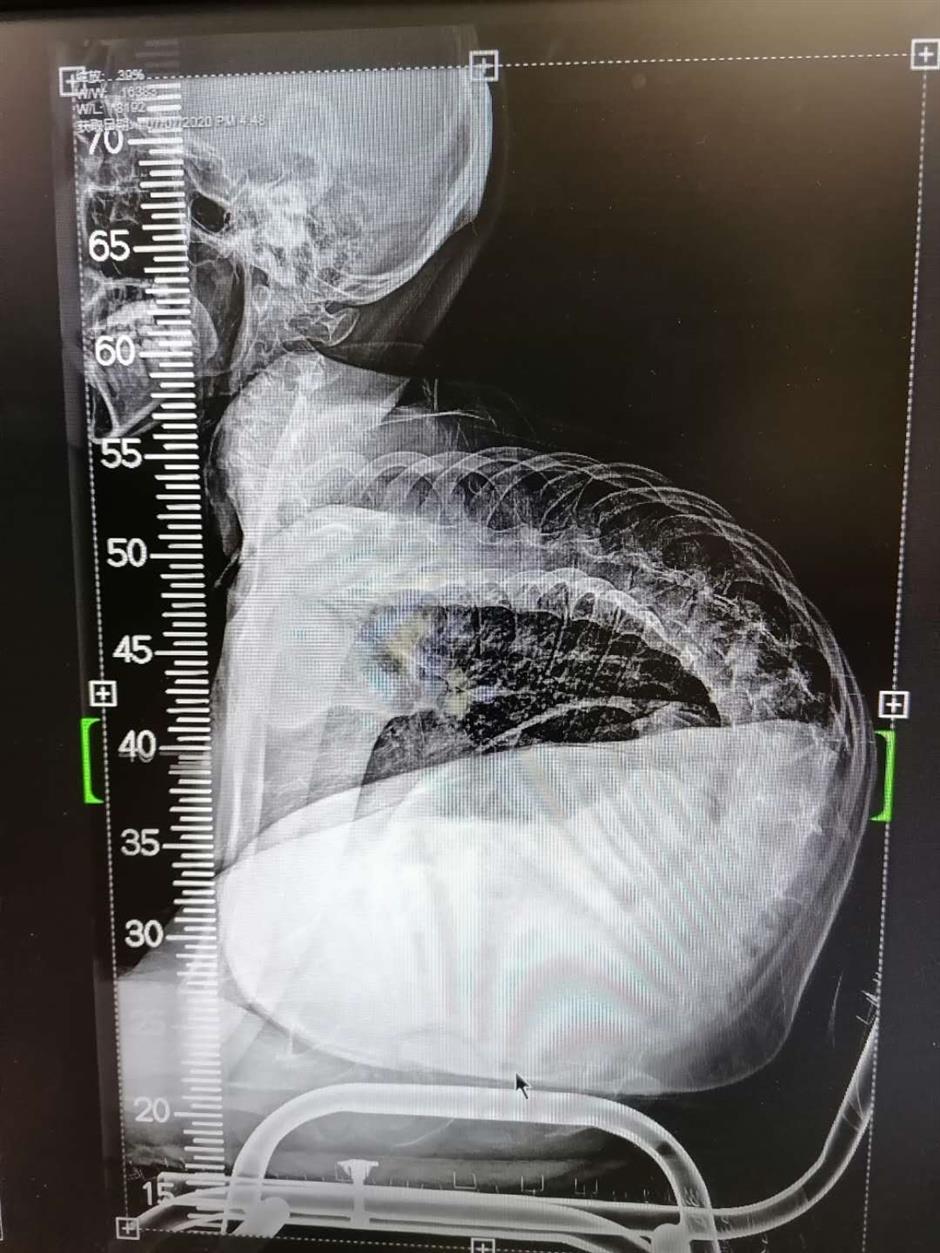 Surgery straightens boy's severely curved spine SHINE News