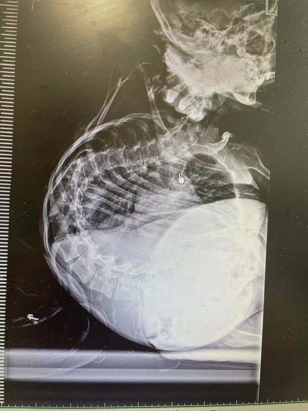 Shanghai doctors set record with curved spine surgery SHINE News