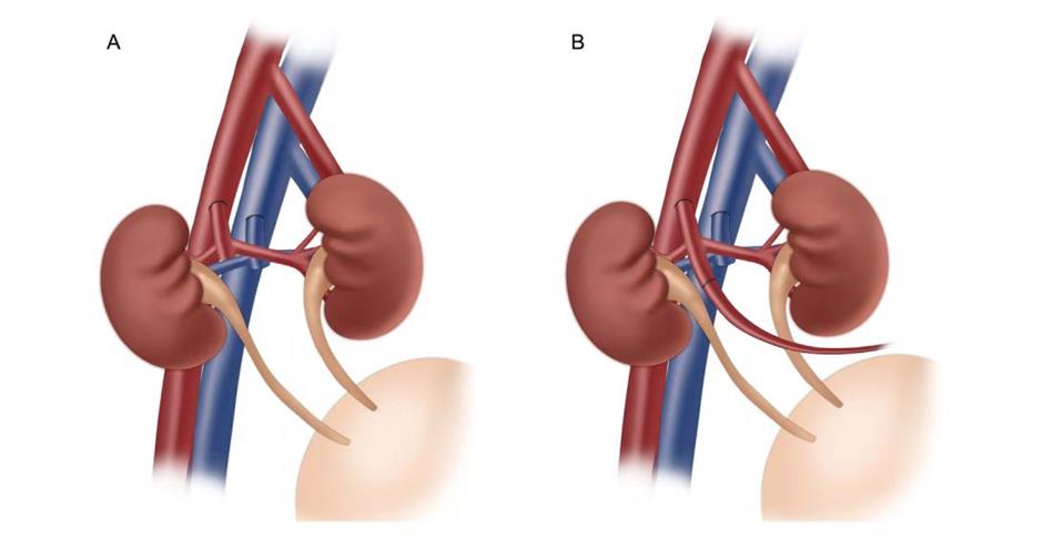 Kidney transplants from premature babies save adult lives