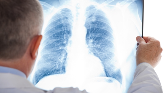 Lung cancer education platform launched in Shanghai