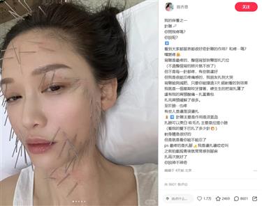 Acupuncture and moxibustion: Ancient Chinese healing gains global appeal