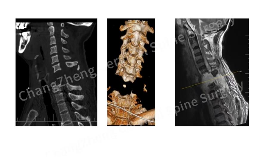 Cervical surgery sensation! Local doctors save man with broken neck