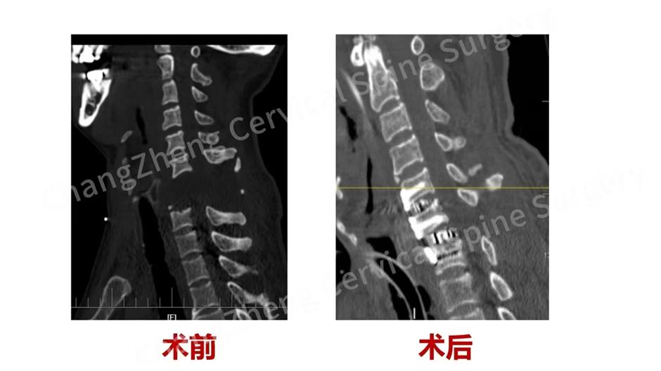 Cervical surgery sensation! Local doctors save man with broken neck