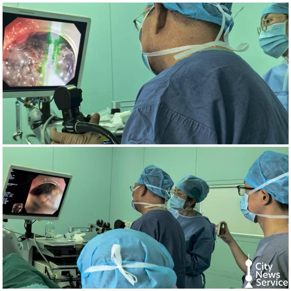 Hairball from Rapunzel Syndrome Removed via Endoscopy at Shanghai Hospital