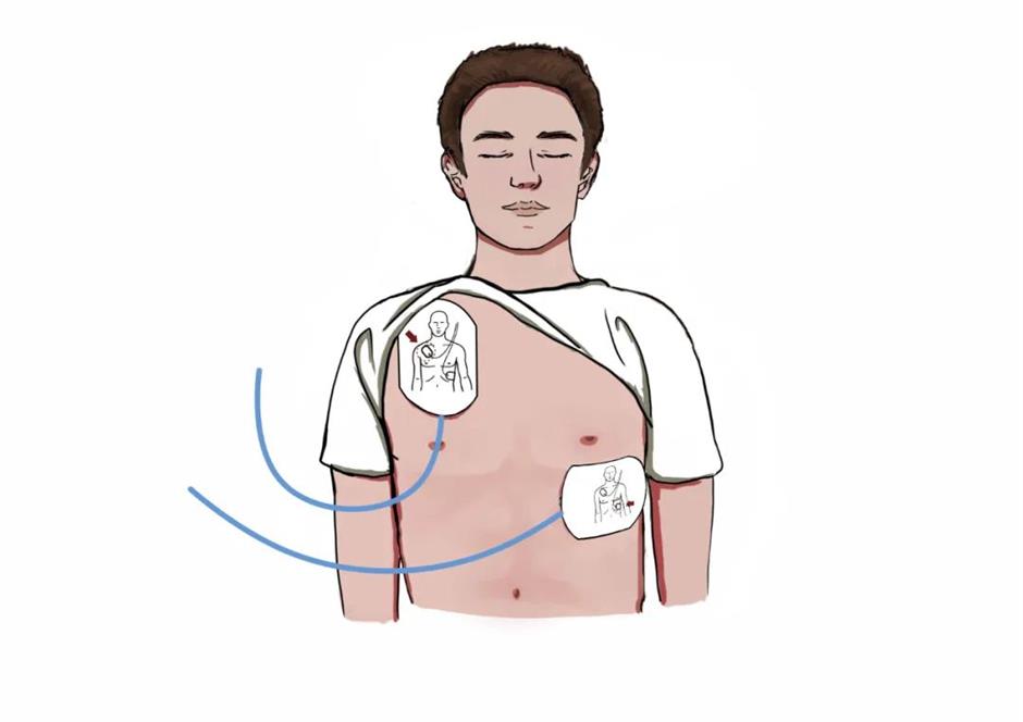 [Explainer] Golden 4 minutes: How to locate and use an AED quickly