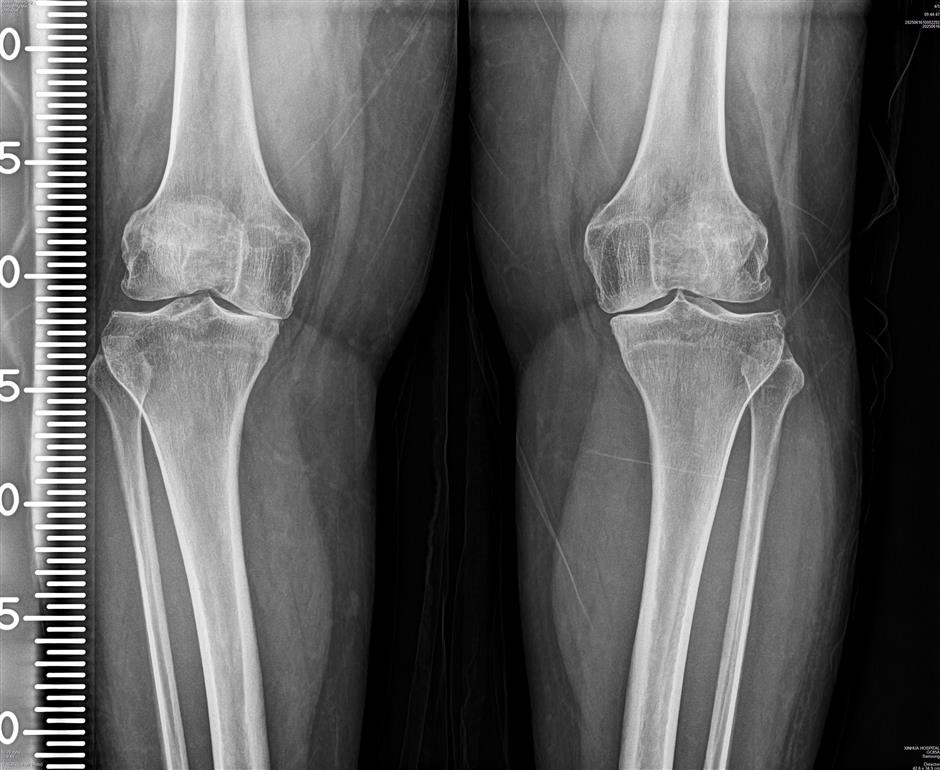 [China Tech] Researchers Develop Targeted Nano-Therapy to Treat Arthritis at the Cellular Level