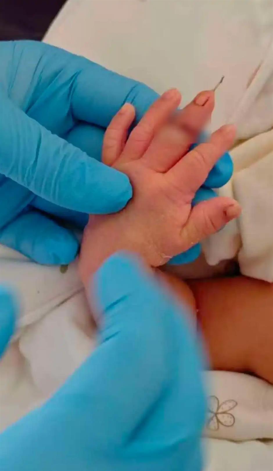 Newborn's Finger Severed in C-Section; Midwife Suspended