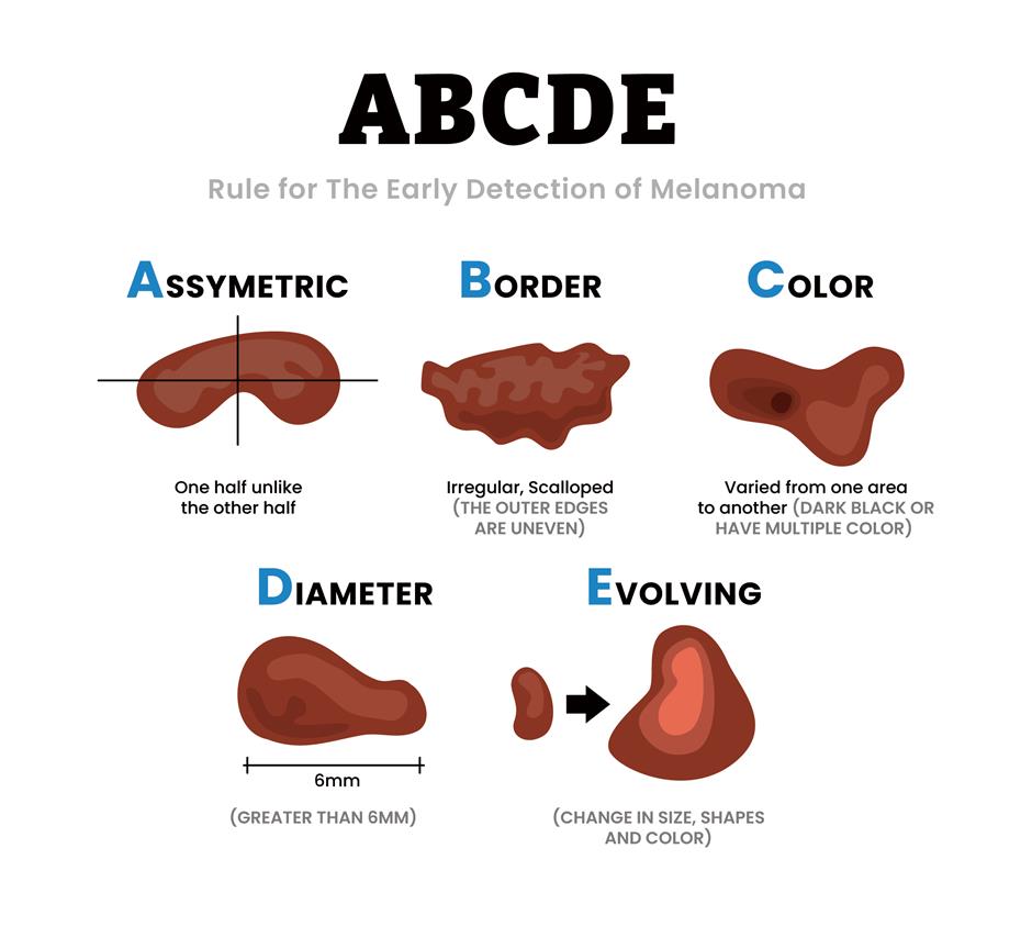 [Health Byte] That Mole You Have Might Be Cancer...