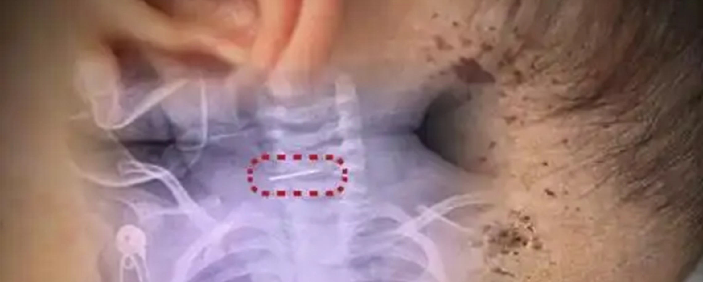 Yunnan Mother Probed for Needle 'Treatment' on Infant