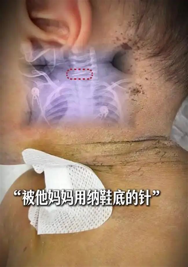 Yunnan Mother Probed for Needle 'Treatment' on Infant