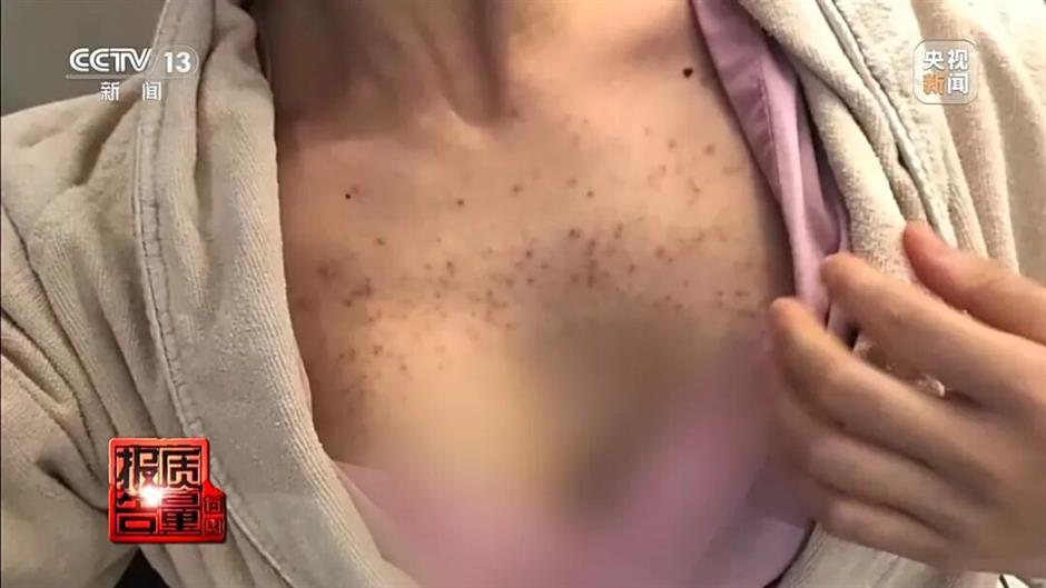 Muscle-Building Shots Leave Woman With Enlarged Adam's Apple