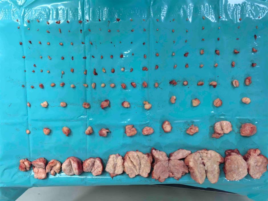 US Woman Advised Hysterectomy Keeps Fertility After Surgeons Remove 656 Fibroids in Shenzhen