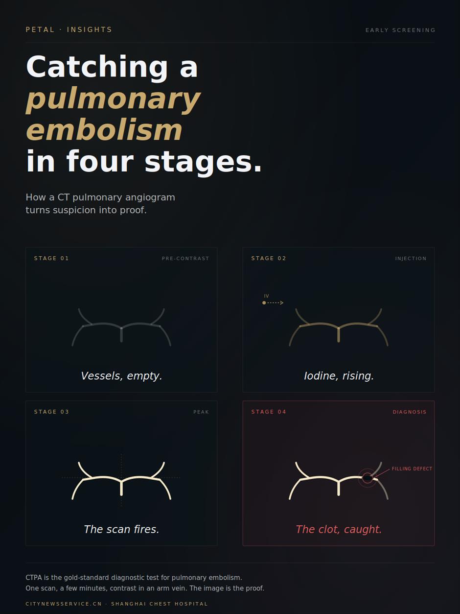 [PETAL Insights] The 10-Second Scan That Finds a Lung Clot