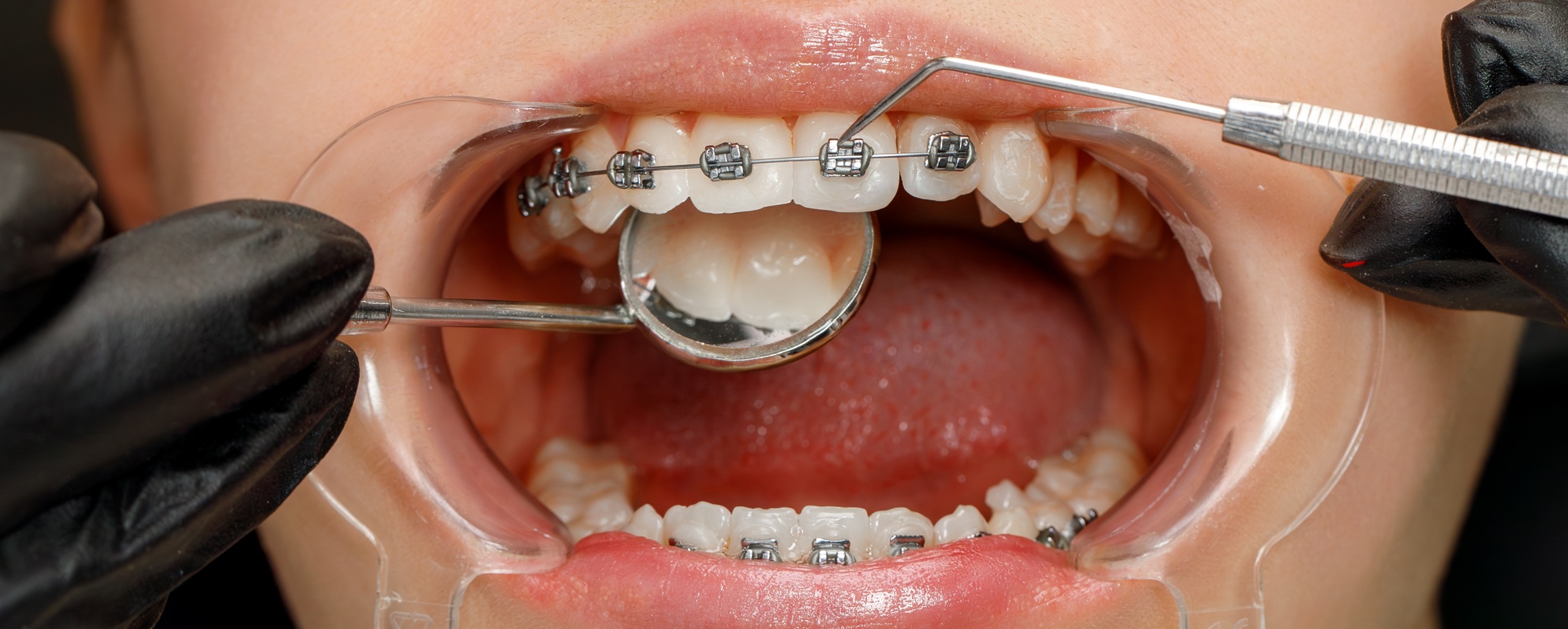 Digital Technology Drives Development of Oral Orthodontics in China
