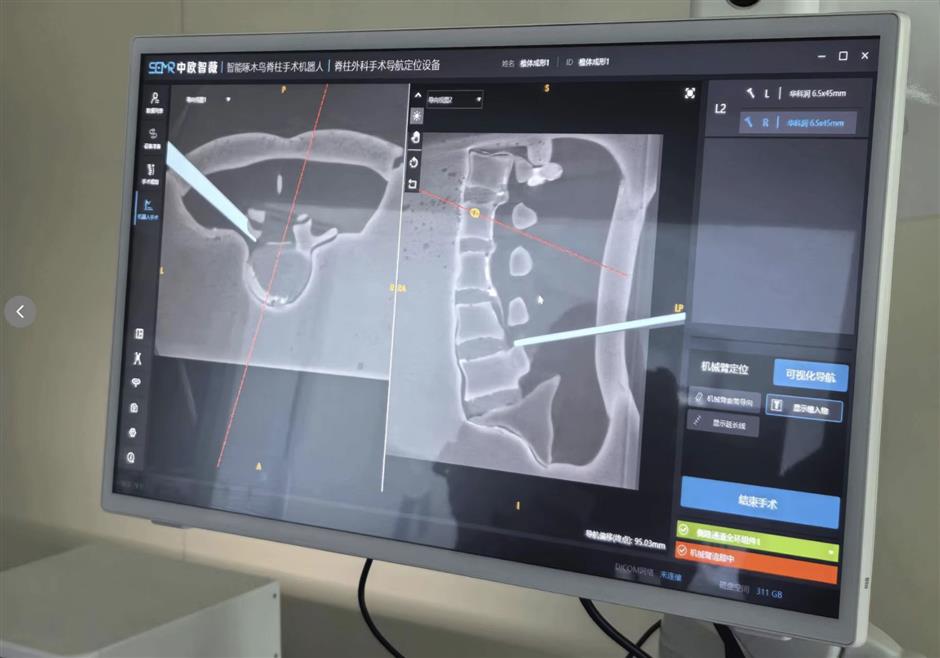 [China Tech] World's First Robotic Digital Platform Powers Smart UBD Spinal Endoscopy