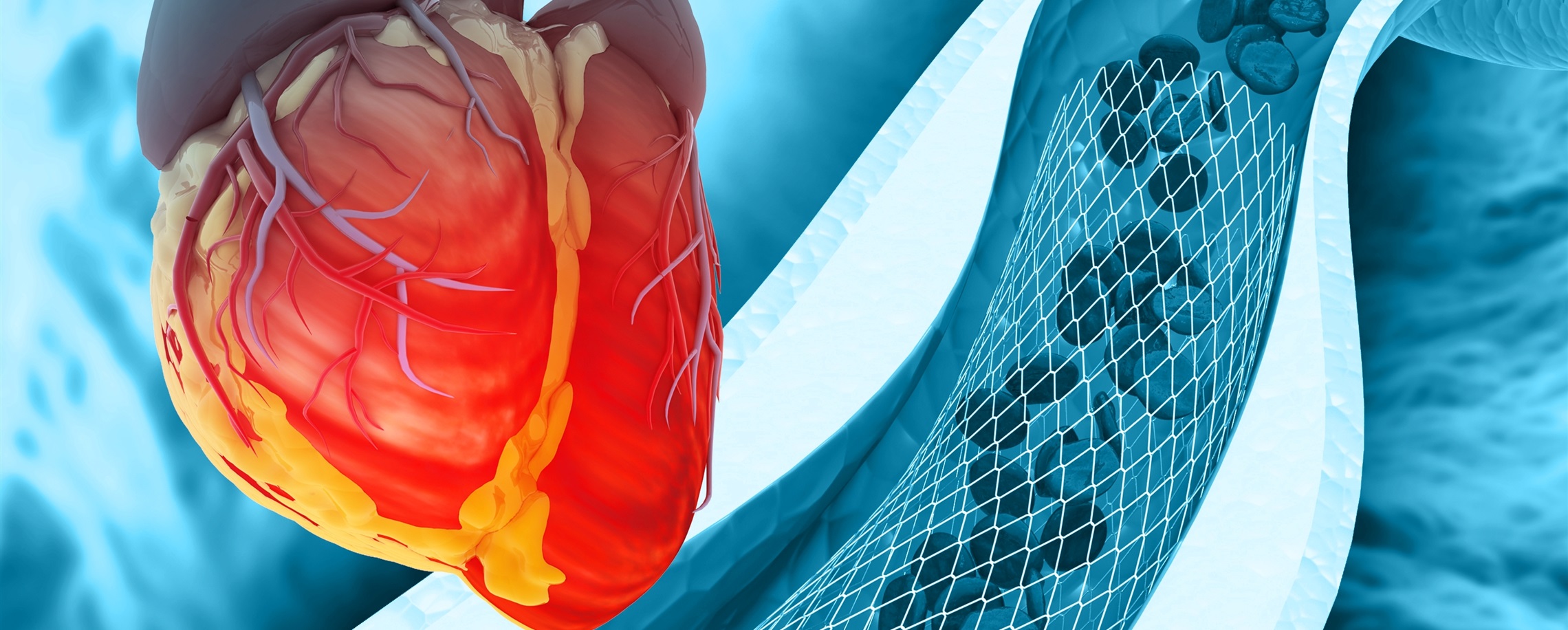 [China Tech] China Achieves Remarkable Progress in Coronary Interventional Cardiology