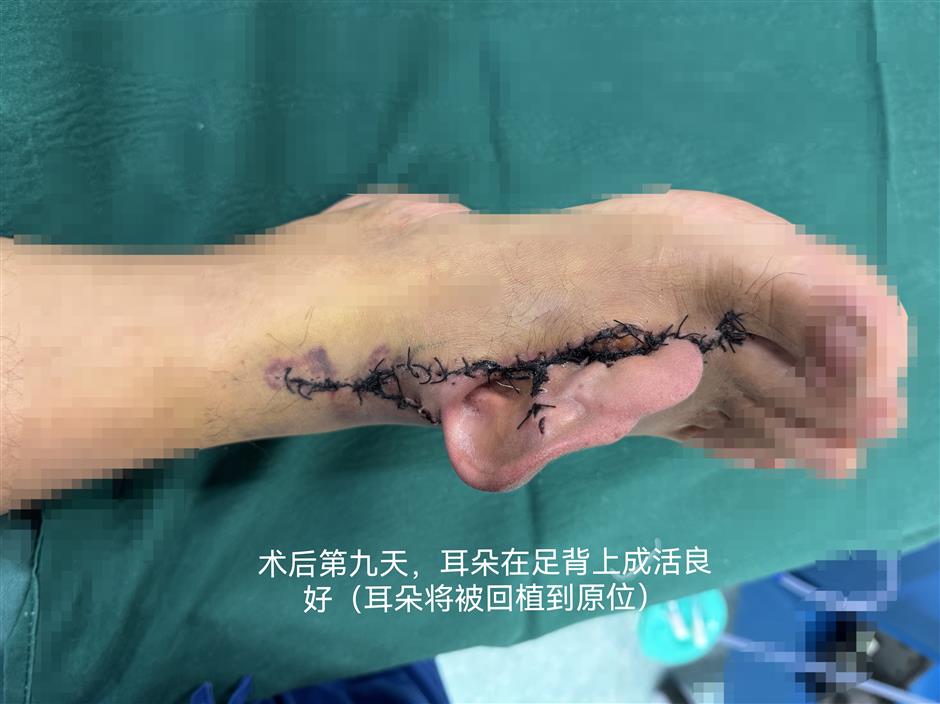 [China Tech] Medical Miracle: Surgeons Reattach Severed Ear After 20 Hours Via Innovative Foot Implant Technique