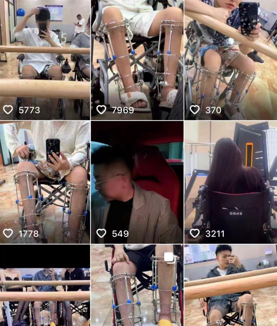 China's Banned Leg-lengthening Surgery Fuels Underground Broker Network