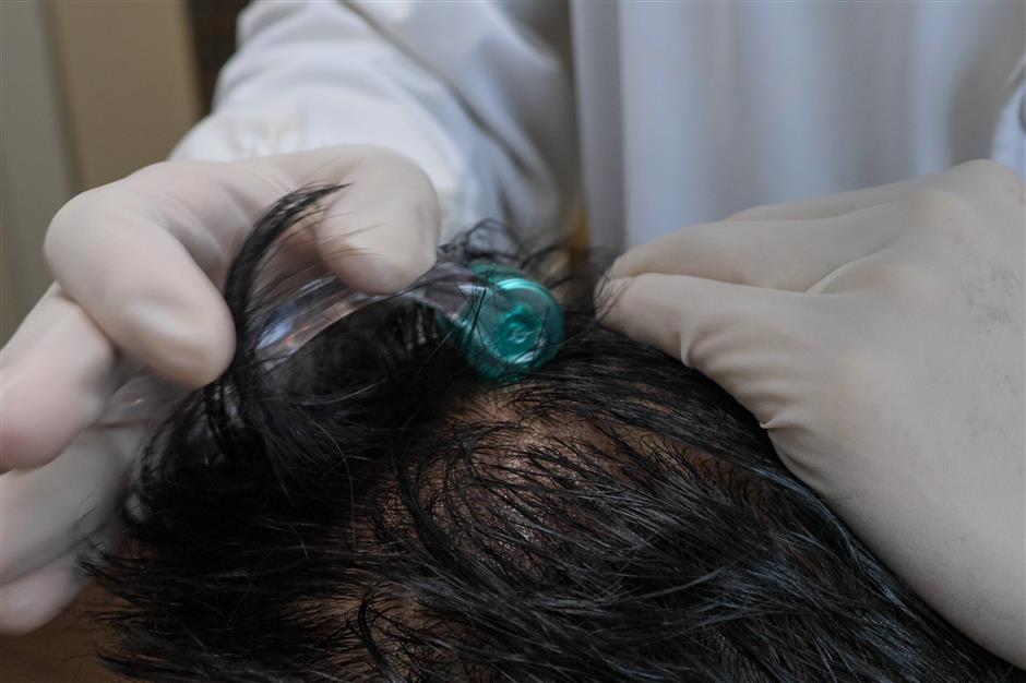 [Health Byte] Hair Loss: Classification, Care and Common Misconceptions