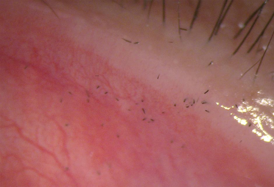 Autumn Danger: Plant Spines That Hurt the Eyes